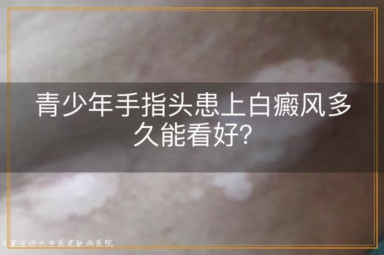 青少年手指头患上白癜风多久能看好？