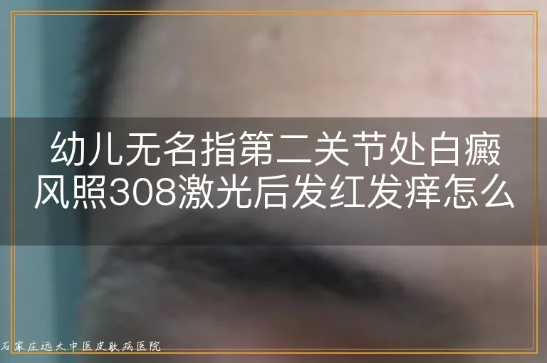 幼儿无名指第二关节处白癜风照308激光后发红发痒怎么处理