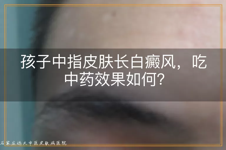 孩子中指皮肤长白癜风，吃中药效果如何？