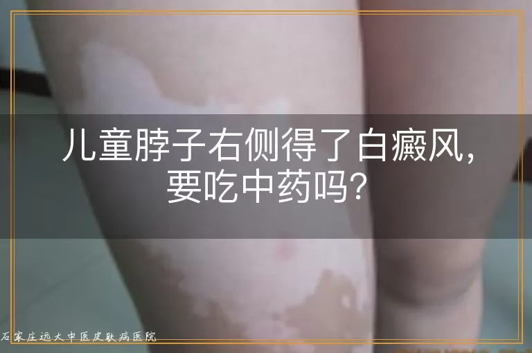 儿童脖子右侧得了白癜风，要吃中药吗？