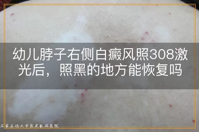 幼儿脖子右侧白癜风照308激光后，照黑的地方能恢复吗？
