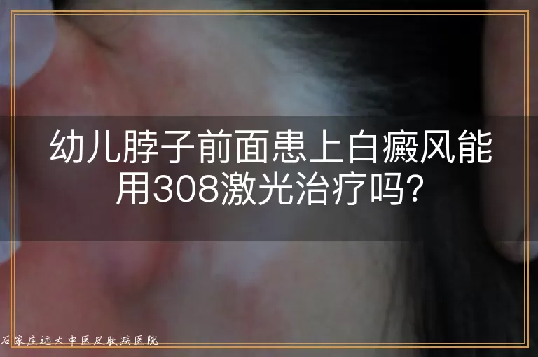 幼儿脖子前面患上白癜风能用308激光治疗吗？