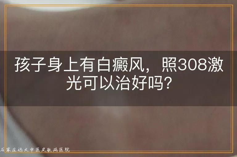 孩子身上有白癜风，照308激光可以治好吗？