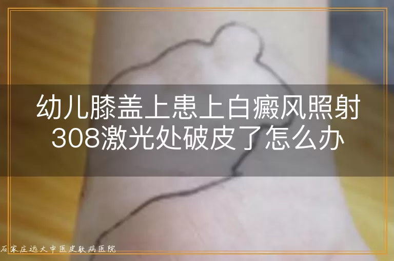 幼儿膝盖上患上白癜风照射308激光处破皮了怎么办
