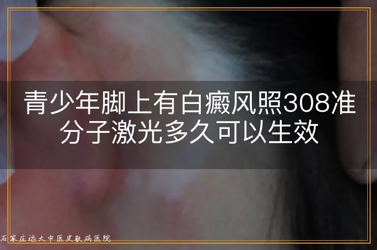 青少年脚上有白癜风照308准分子激光多久可以生效