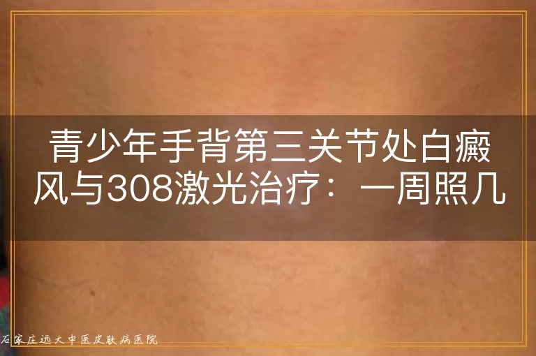 青少年手背第三关节处白癜风与308激光治疗：一周照几次最合适？