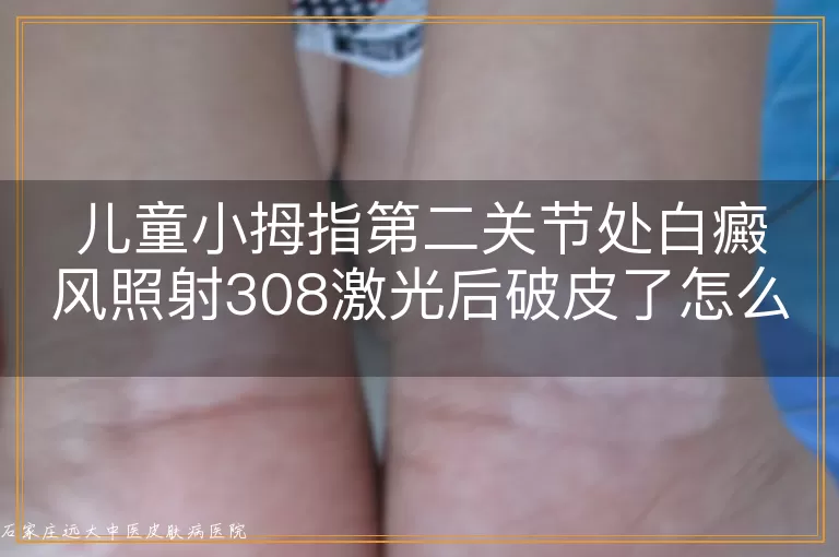 儿童小拇指第二关节处白癜风照射308激光后破皮了怎么办