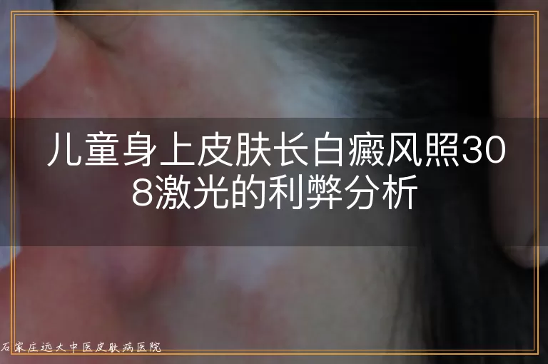 儿童身上皮肤长白癜风照308激光的利弊分析