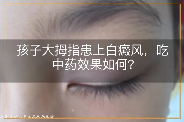 孩子大拇指患上白癜风,吃中药效果如何?