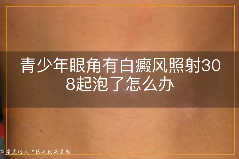 青少年眼角有白癜风照射308起泡了怎么办