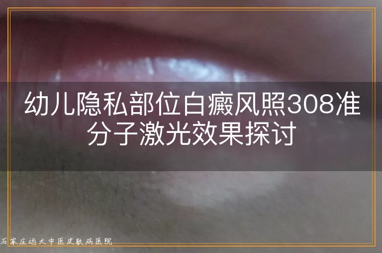 幼儿隐私部位白癜风照308准分子激光效果探讨