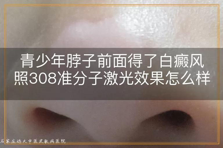 青少年脖子前面得了白癜风照308准分子激光效果怎么样