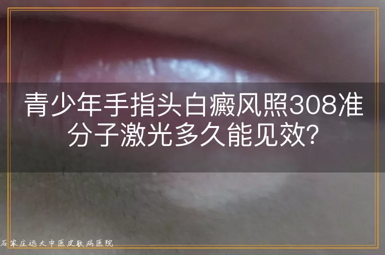 青少年手指头白癜风照308准分子激光多久能见效？
