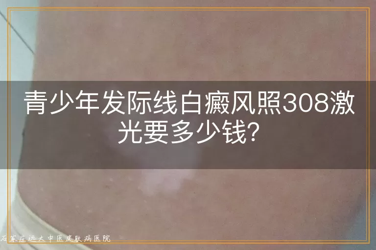 青少年发际线白癜风照308激光要多少钱？