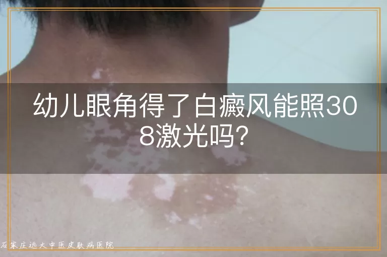 幼儿眼角得了白癜风能照308激光吗？