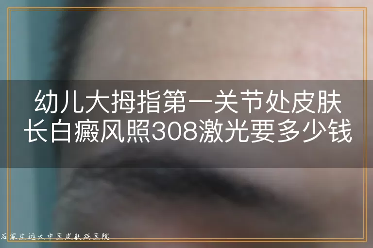 幼儿大拇指第一关节处皮肤长白癜风照308激光要多少钱？