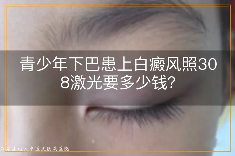 青少年下巴患上白癜风照308激光要多少钱？