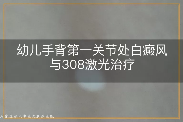 幼儿手背第一关节处白癜风与308激光治疗