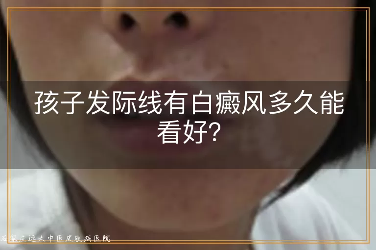 孩子发际线有白癜风多久能看好？