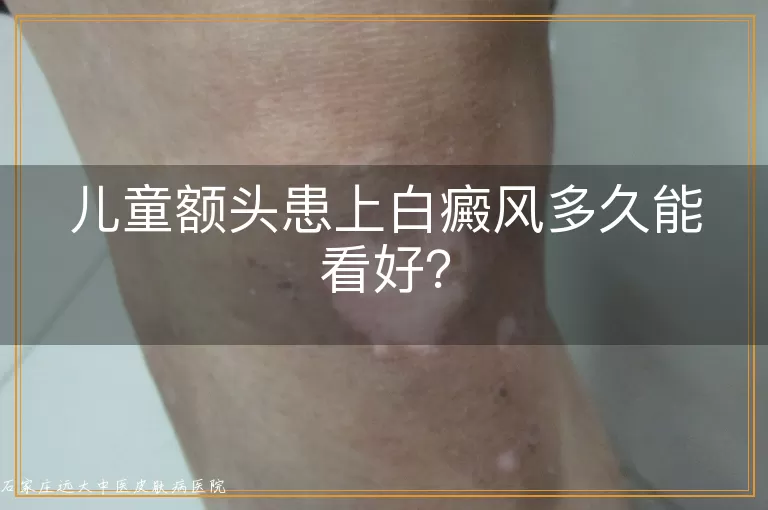儿童额头患上白癜风多久能看好？