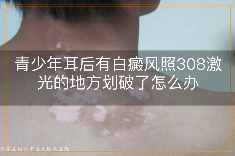 青少年耳后有白癜风照308激光的地方划破了怎么办