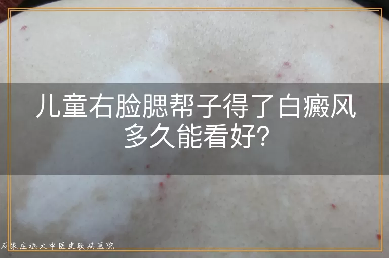 儿童右脸腮帮子得了白癜风多久能看好？