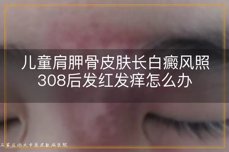 儿童肩胛骨皮肤长白癜风照308后发红发痒怎么办