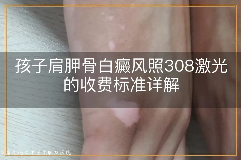 孩子肩胛骨白癜风照308激光的收费标准详解