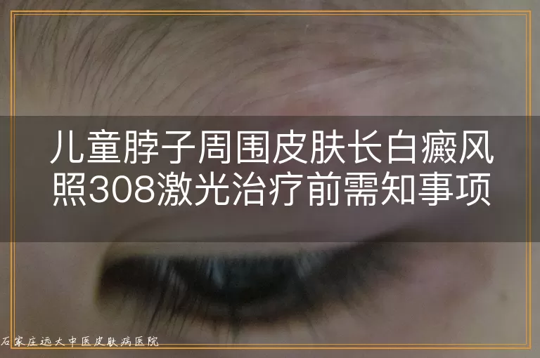 儿童脖子周围皮肤长白癜风照308激光治疗前需知事项