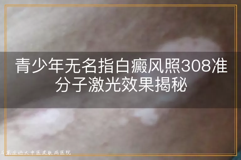 青少年无名指白癜风照308准分子激光效果揭秘
