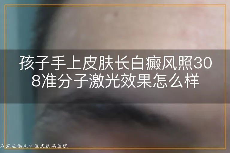 孩子手上皮肤长白癜风照308准分子激光效果怎么样