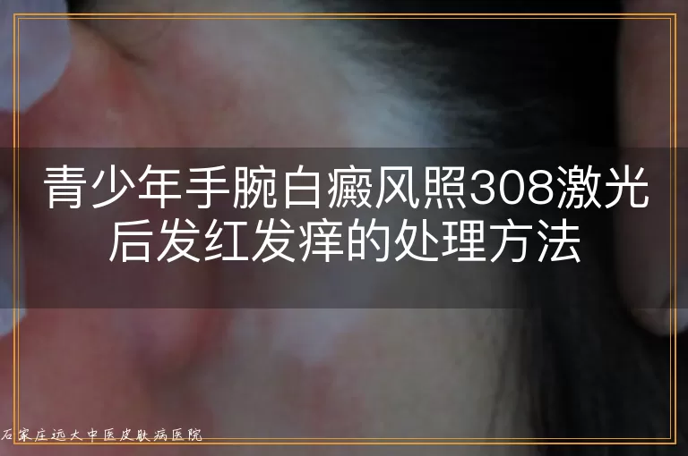 青少年手腕白癜风照308激光后发红发痒的处理方法