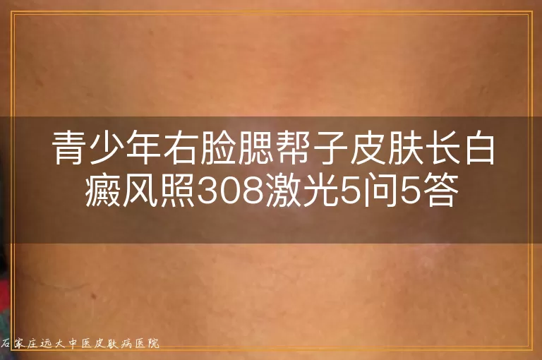 青少年右脸腮帮子皮肤长白癜风照308激光5问5答