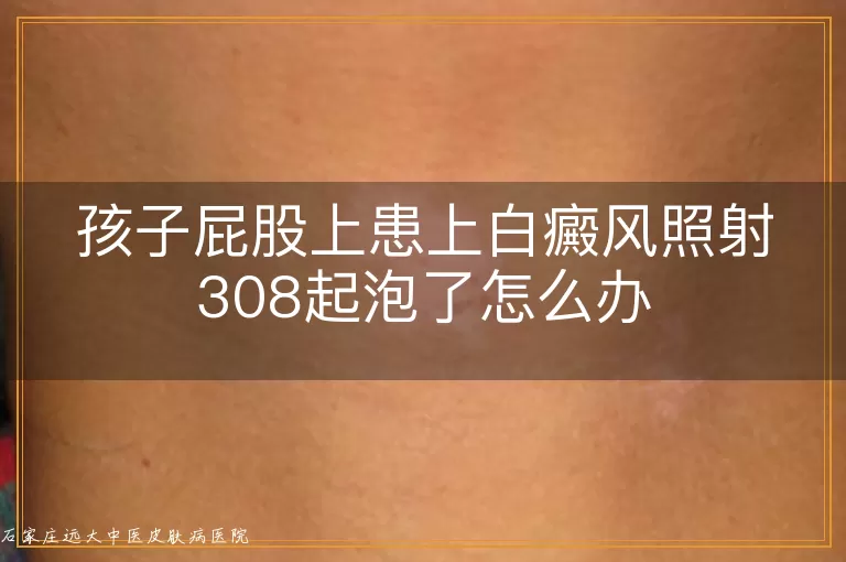 孩子屁股上患上白癜风照射308起泡了怎么办