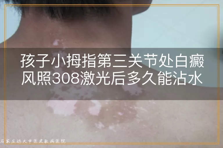 孩子小拇指第三关节处白癜风照308激光后多久能沾水