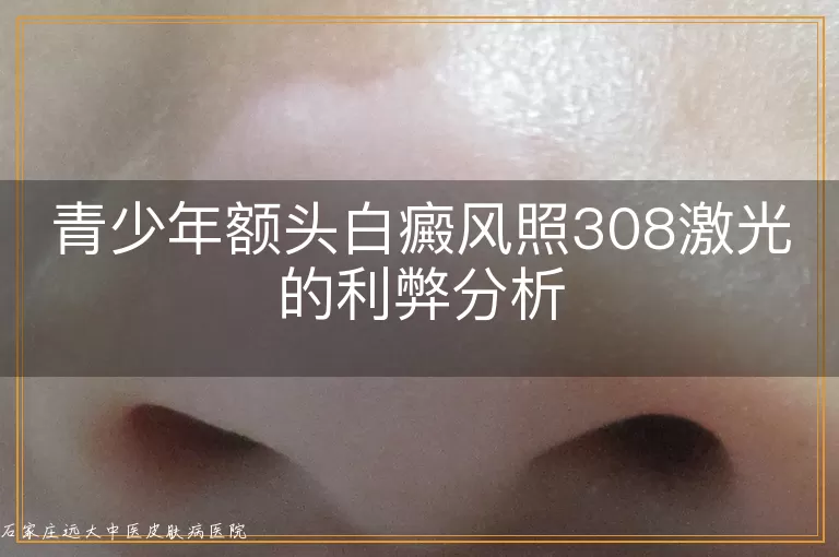 青少年额头白癜风照308激光的利弊分析
