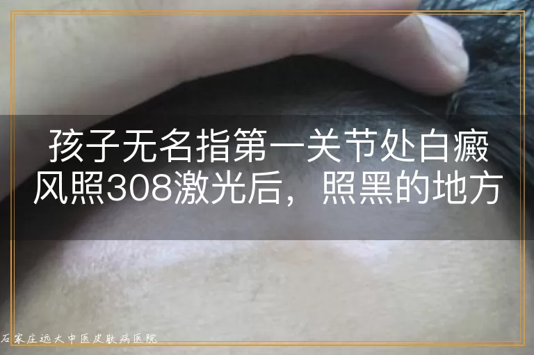 孩子无名指第一关节处白癜风照308激光后，照黑的地方能恢复吗？