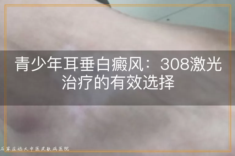 青少年耳垂白癜风：308激光治疗的有效选择