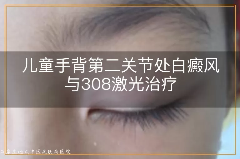 儿童手背第二关节处白癜风与308激光治疗