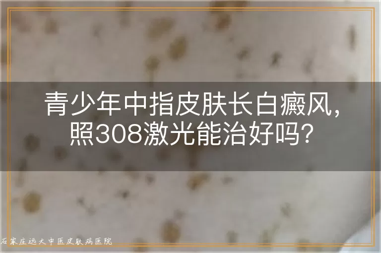 青少年中指皮肤长白癜风，照308激光能治好吗？