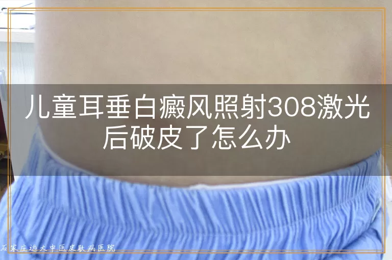 儿童耳垂白癜风照射308激光后破皮了怎么办