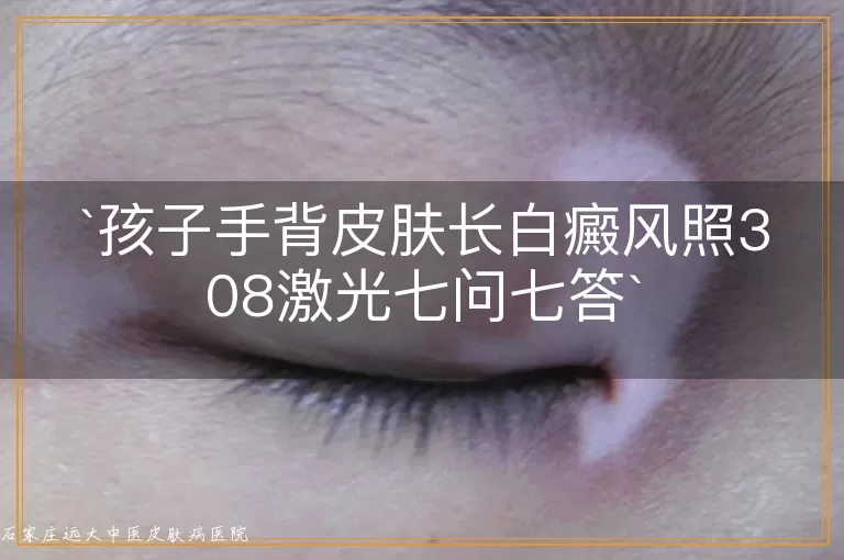 孩子手背皮肤长白癜风照308激光七问七答