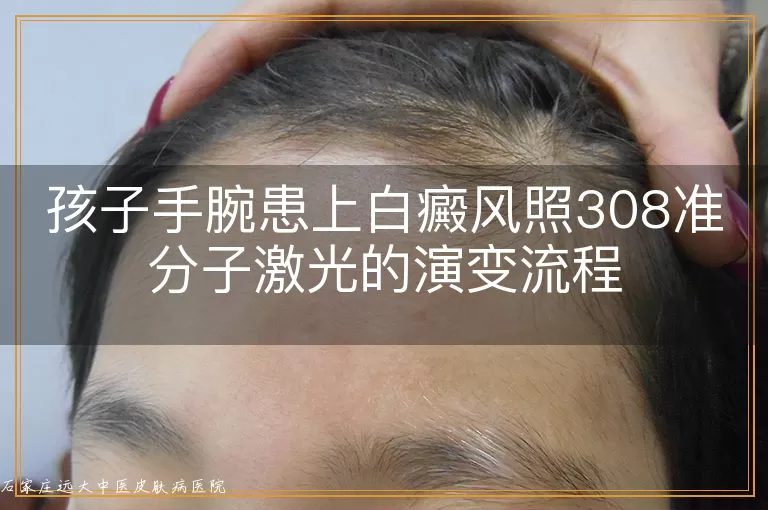 孩子手腕患上白癜风照308准分子激光的演变流程