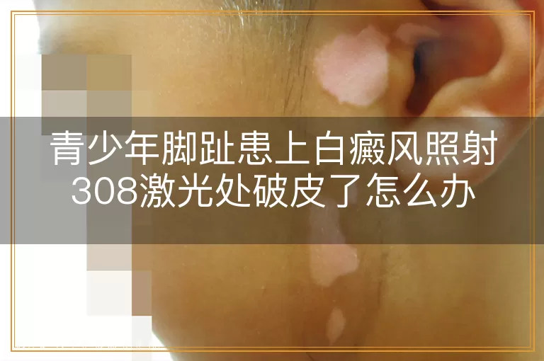 青少年脚趾患上白癜风照射308激光处破皮了怎么办