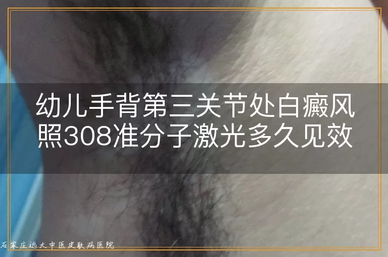 幼儿手背第三关节处白癜风照308准分子激光多久见效