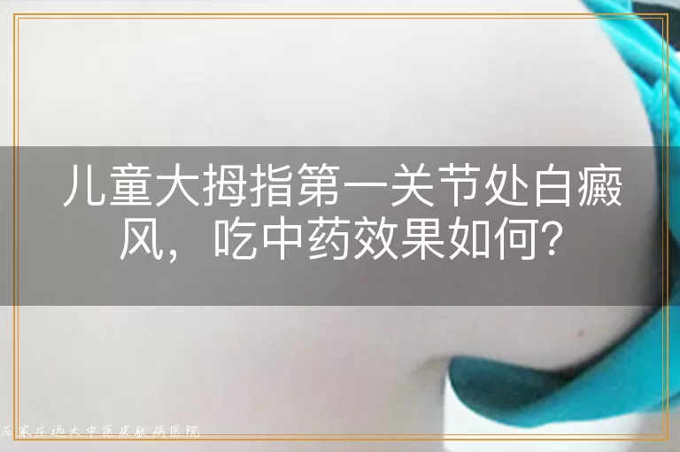儿童大拇指第一关节处白癜风，吃中药效果如何？