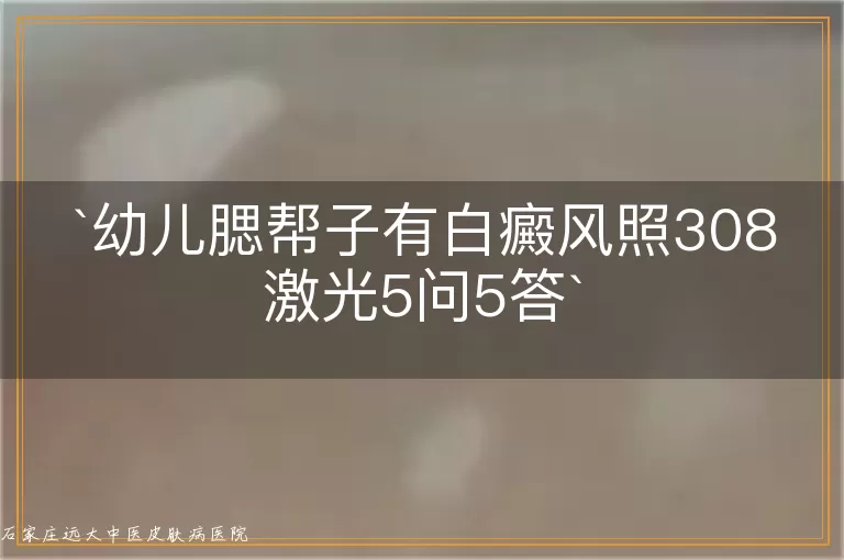 幼儿腮帮子有白癜风照308激光5问5答