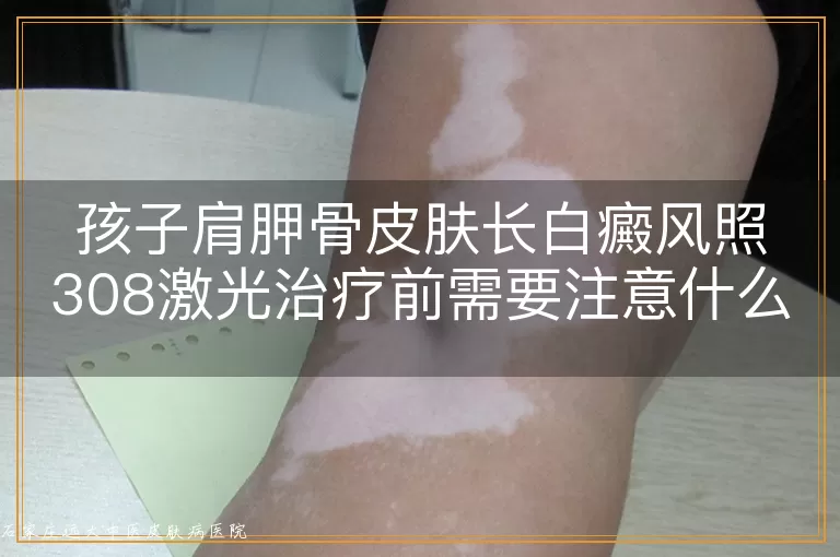 孩子肩胛骨皮肤长白癜风照308激光治疗前需要注意什么