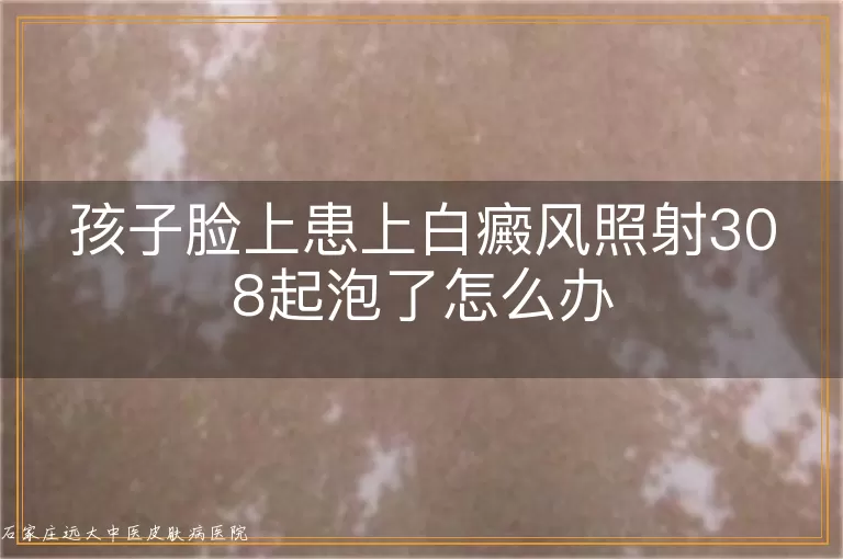 孩子脸上患上白癜风照射308起泡了怎么办