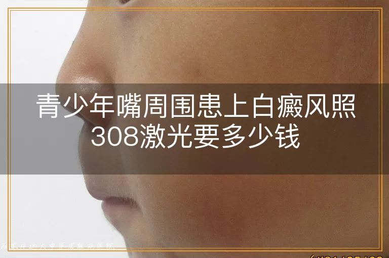 青少年嘴周围患上白癜风照308激光要多少钱